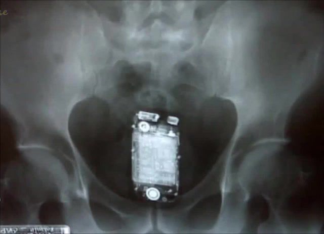 Top most weird objects found in human rectum x ray, top, 20, most, weird, objects, found, in, human, rectum, colon, fail, x ray, xray, horrifying, accident, funny fail, objects found, top 20, most weird, wtf, youtube, science technology.
