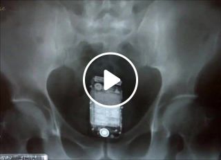 Top Most Weird Objects Found In Human Rectum X Ray